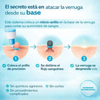 Kit completo para eliminar las verrugas en 1 semana