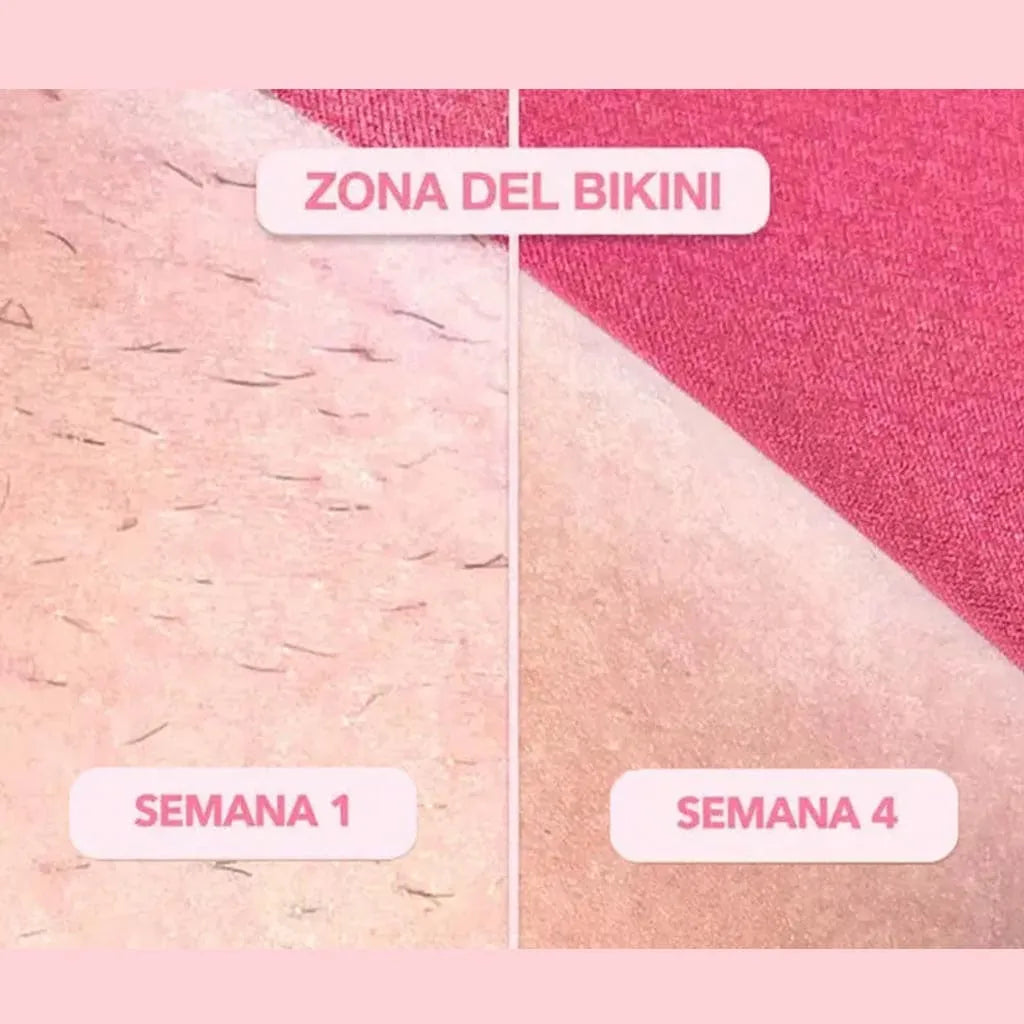 SkinUp®  Depilacion laser profesional en casa