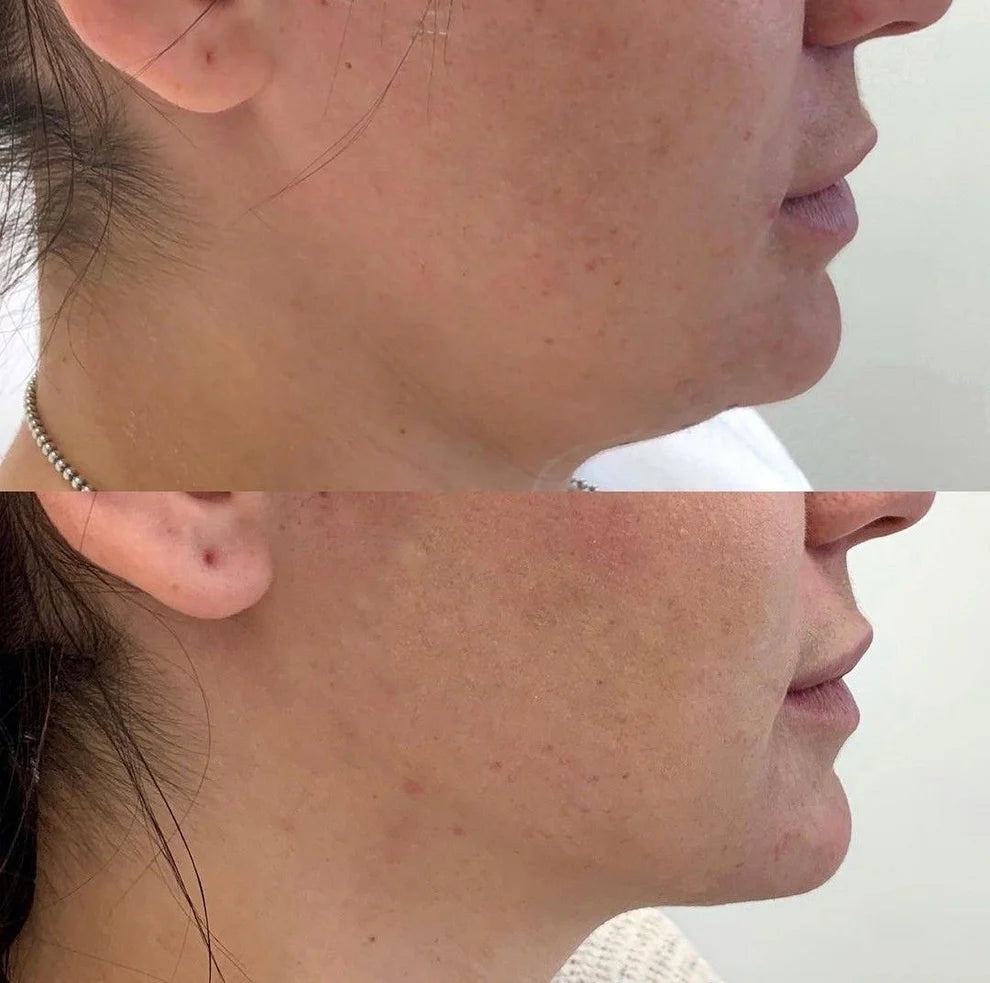 LumiLift® Tecnologia profesional para uso en casa